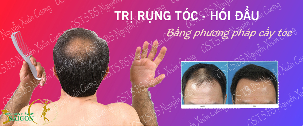 Cấy tóc tự thân do GS.TS.BS Nguyễn Xuân Cương thực hiện