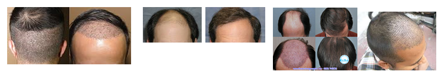  Today, hair transplant is considered one of the most effective solutions to restore hair for people with hair loss, baldness, scarring of the head area ... especially hair transplants are also used to transplant eyebrows, eyelashes, eyelashes. belly, leg hair, capillary ...  In the current hair transplant techniques, the advanced hair transplant technique FUE (Follicular Unit Extraction), also known as the hair transplant technique, is considered the perfect and best technique. Because this technique does not need to cut a piece of the back scalp to get the hair, the hair is removed one by one for transplanting with a hair shaft drill with a very small diameter of about 1 mm.
